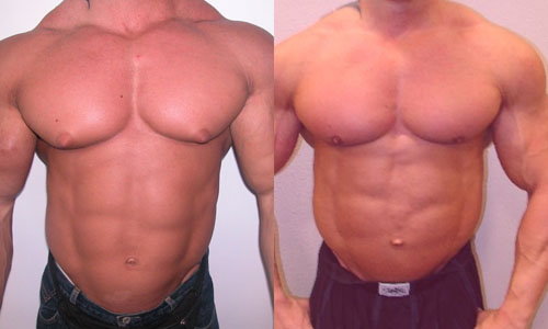 gynecomastia